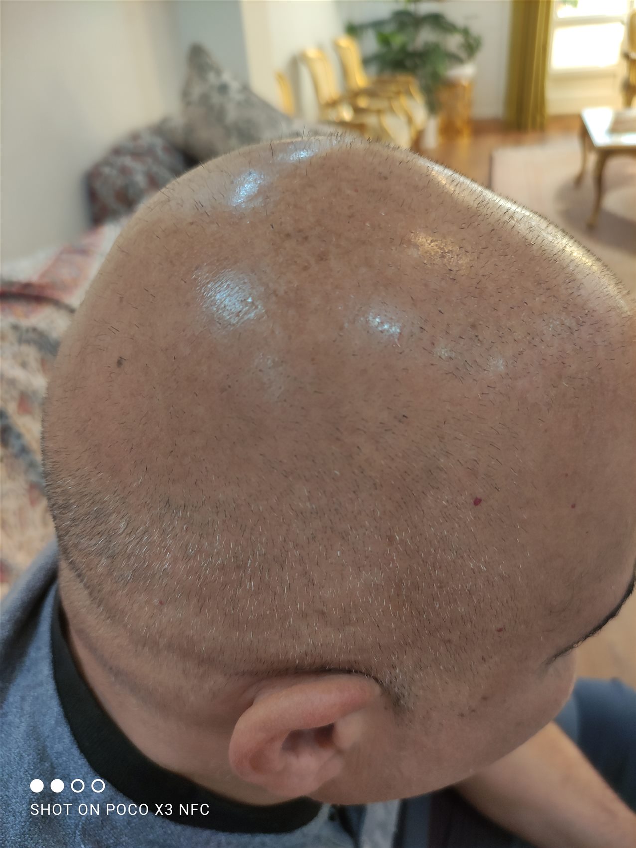 صورة من أعمال المكياج الدائم: تصبغ فروة الرأس — المرحلة الأولى