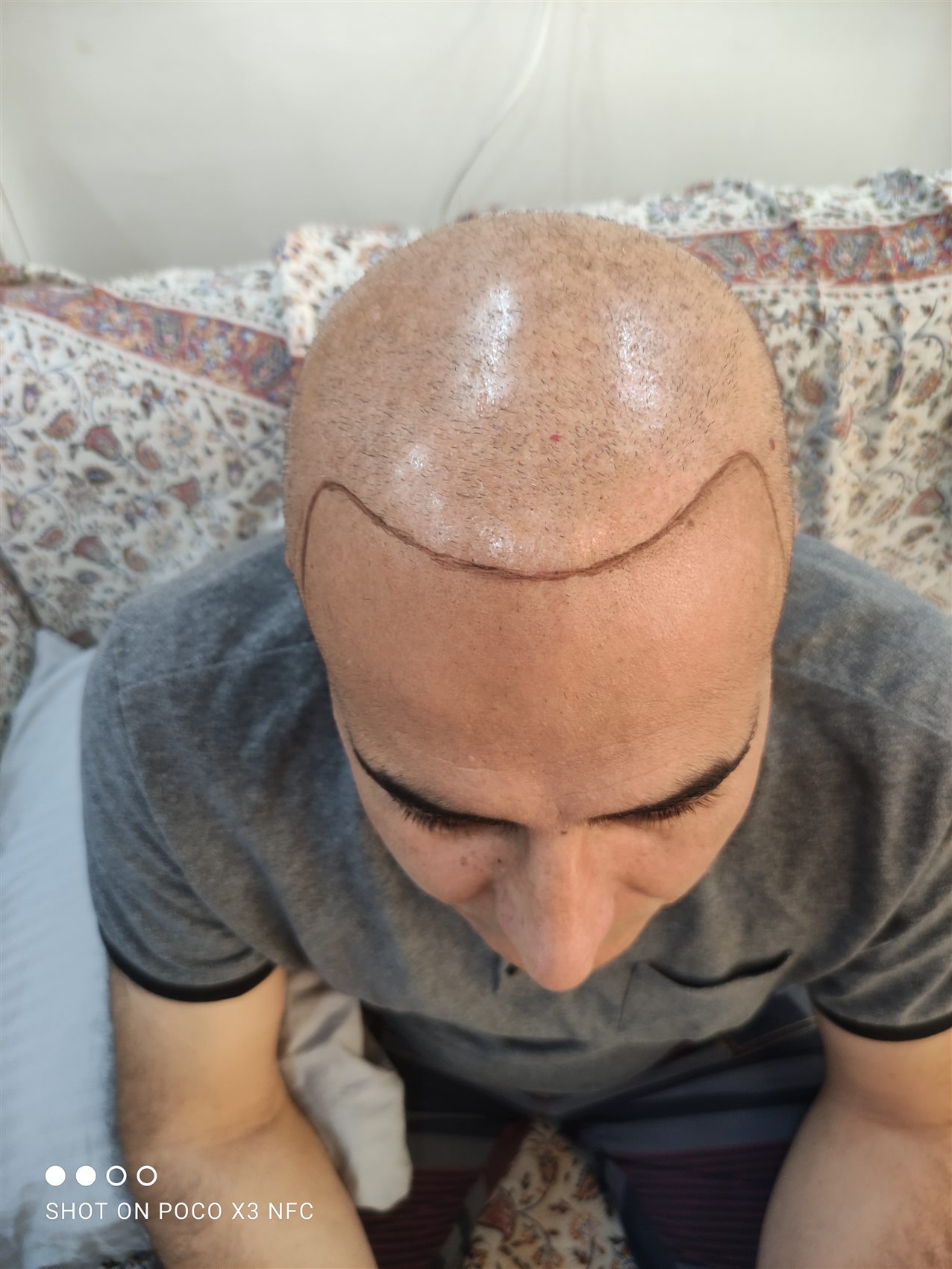 تراکم‌سازی اسکالپ — اسکالپ