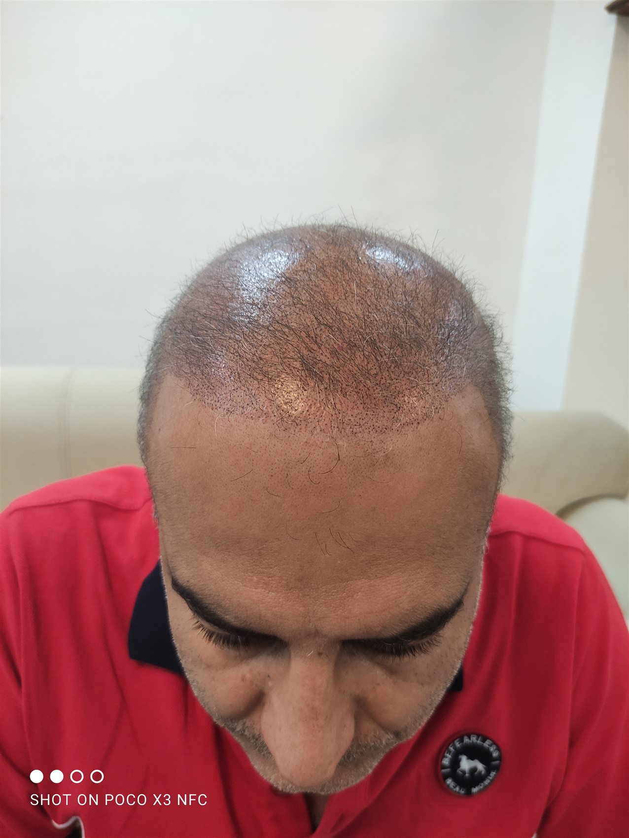 صورة من أعمال المكياج الدائم: مراحل إجراء تصبغ فروة الرأس